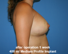 plastic-surgery-breast-augmentation